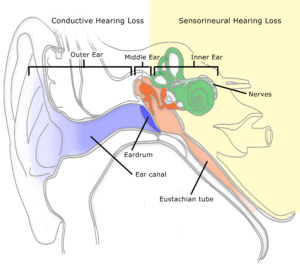 fye-types-of-hearing-loss-illust